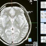 dispozitiv monitorizare cerebrala pentru doze anestezie