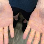 Colesterolul i-a invadat organismul după opt luni de dietă extremă. A mâncat doar ouă, carne și brânză