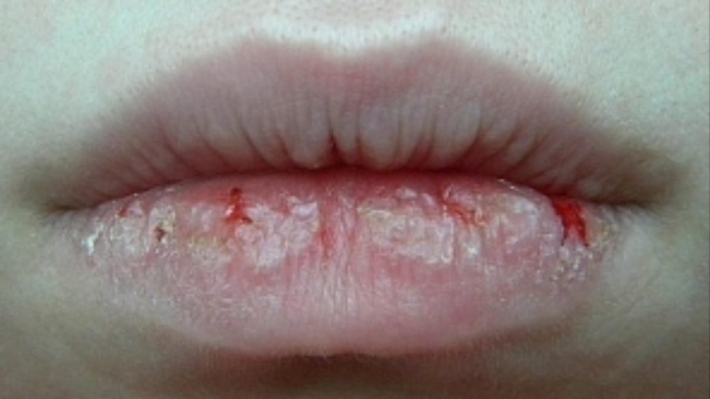 Cum scapi de buzele crăpate. Remediul ieftin și natural pe care trebuie să îl folosești în sezonul rece