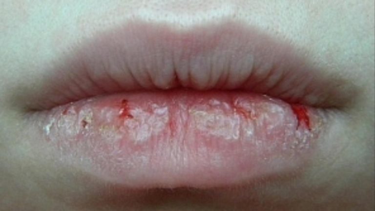 Cum scapi de buzele crăpate. Remediul ieftin și natural pe care trebuie să îl folosești în sezonul rece