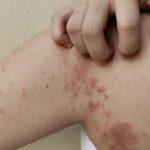 Ce trebuie să știi despre lepră: cum se transmite și ce simptome are? A revenit în România după 44 de ani