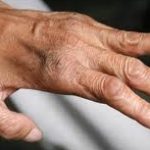 Un nou caz de lepră a fost confirmat la Cluj-Napoca. Sunt primele două cazuri înregistrate în România din 1981