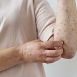 Creșterea alarmantă a cazurilor de varicelă în România: Un apel la conștientizare și acțiune